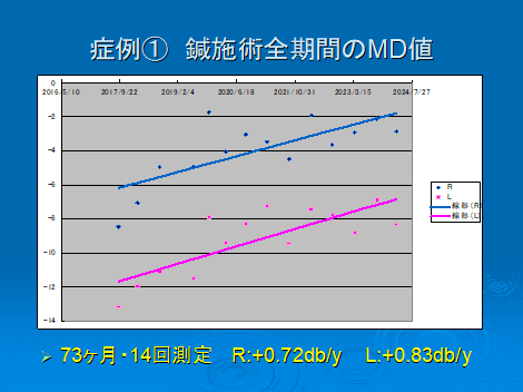 緑内障性視野障害　MD値改善　長期経過