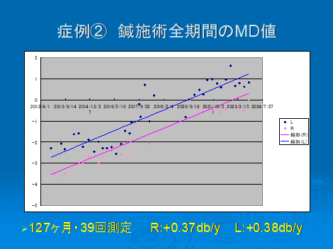 緑内障性視野障害　MD値改善　長期経過