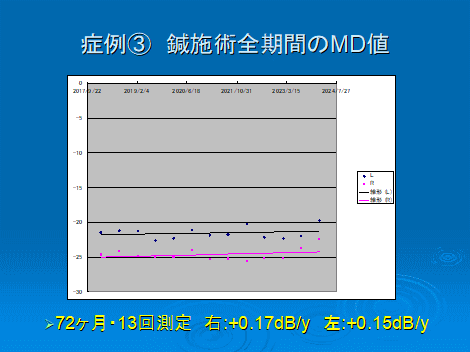 緑内障性視野障害　MD値改善　長期経過
