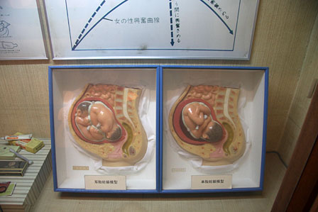 双子の胎児模型